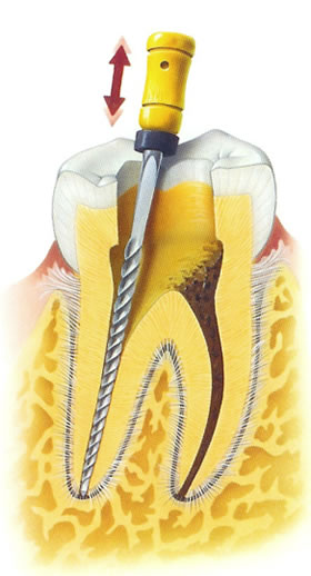 realizacion endodoncias por especialistas dentales